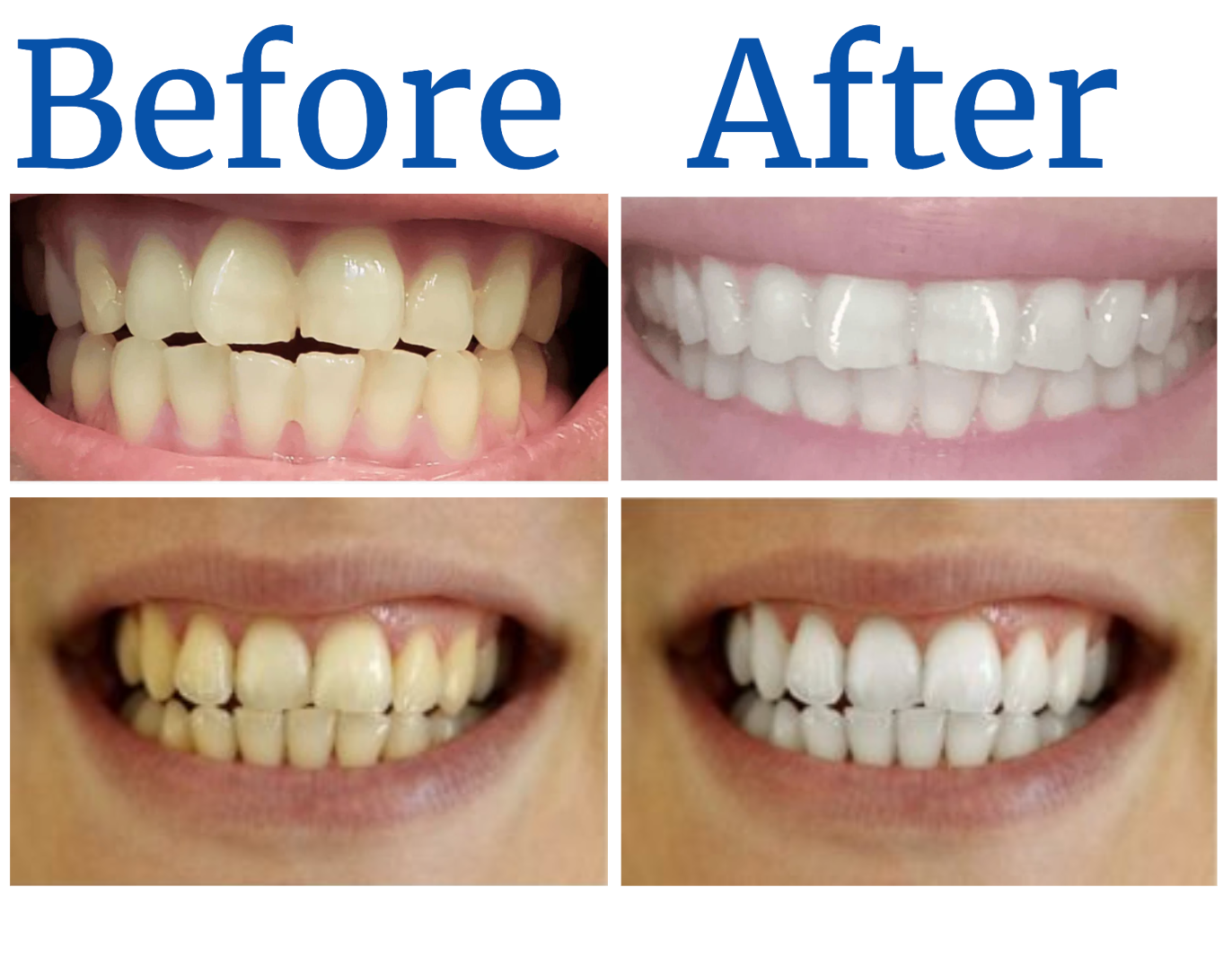 Purezza Teeth Whitening Serum