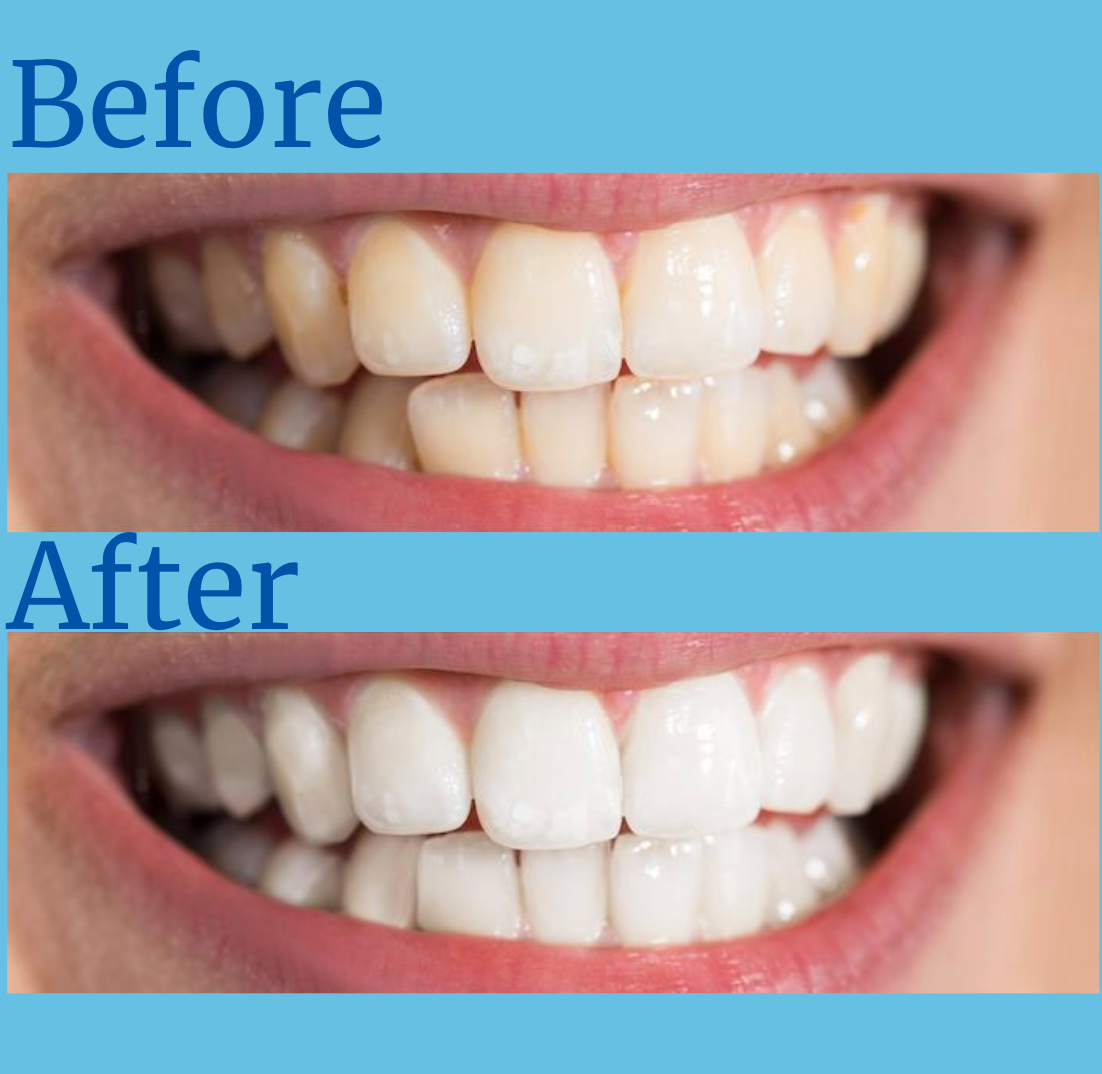 Purezza Teeth Whitening Serum – Teeth bleaching kit for safe, professional whitening at home